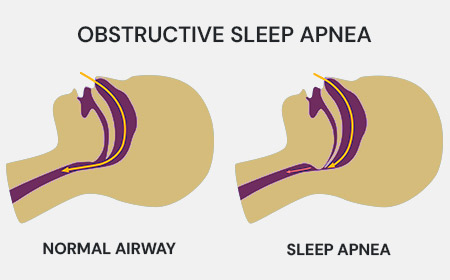 Airway Related Functional Dentistry