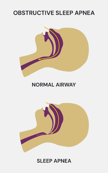 Airway Related Functional Dentistry