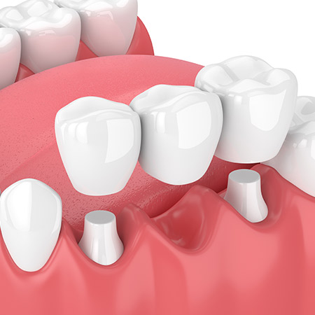 Dental Bridges