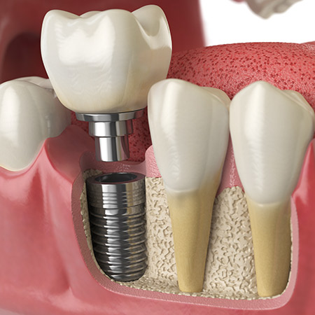 Dental Implants