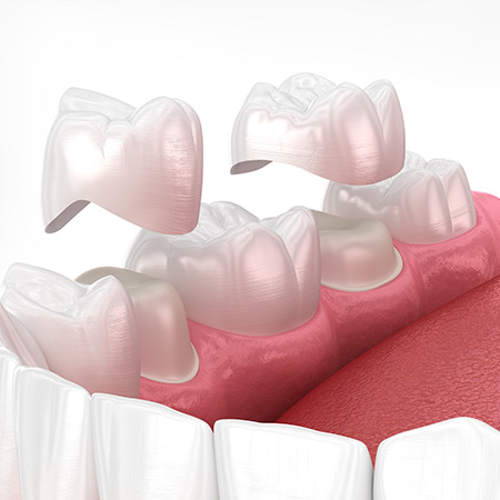 Dental Crowns