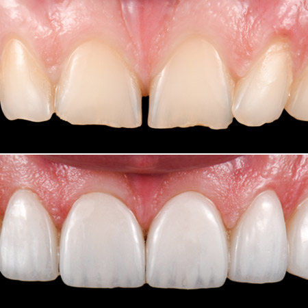 Dental Veneers