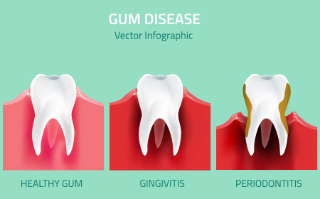 Gum Disease