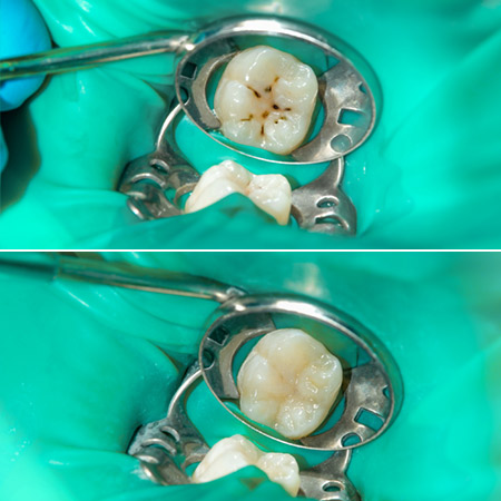 Composite Fillings / Restorations