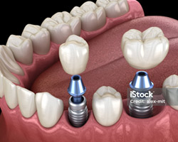 Single or Multiple unit Implants