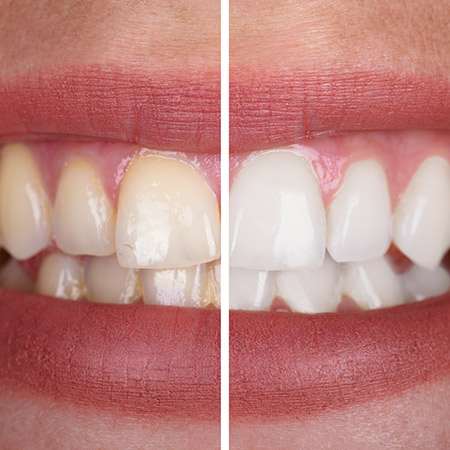 Teeth Whitening