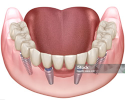Single or Multiple unit Implants